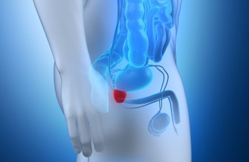 La incidencia del cáncer de próstata avanzado (metastásico ) es de casi el doble